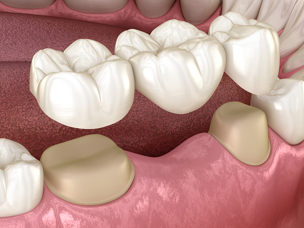 Picture of Dental Bridge