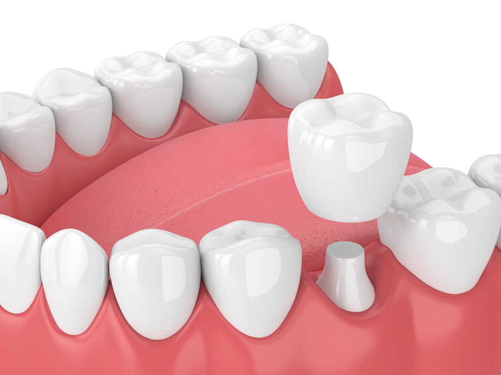 Picture of Dental Crowns