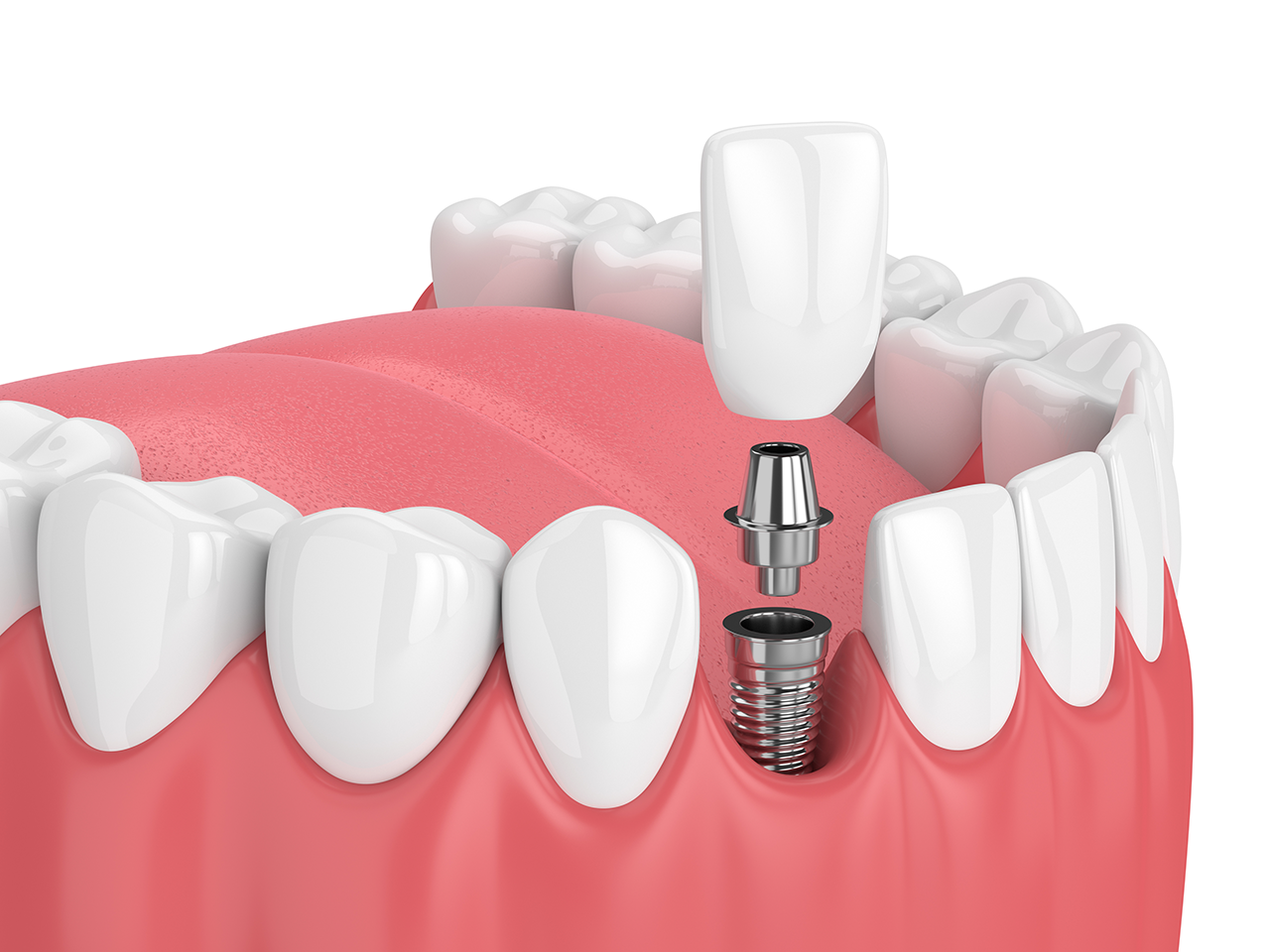 Picture of Dental Implant