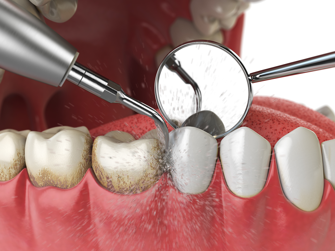 Picture of Periodontal Care