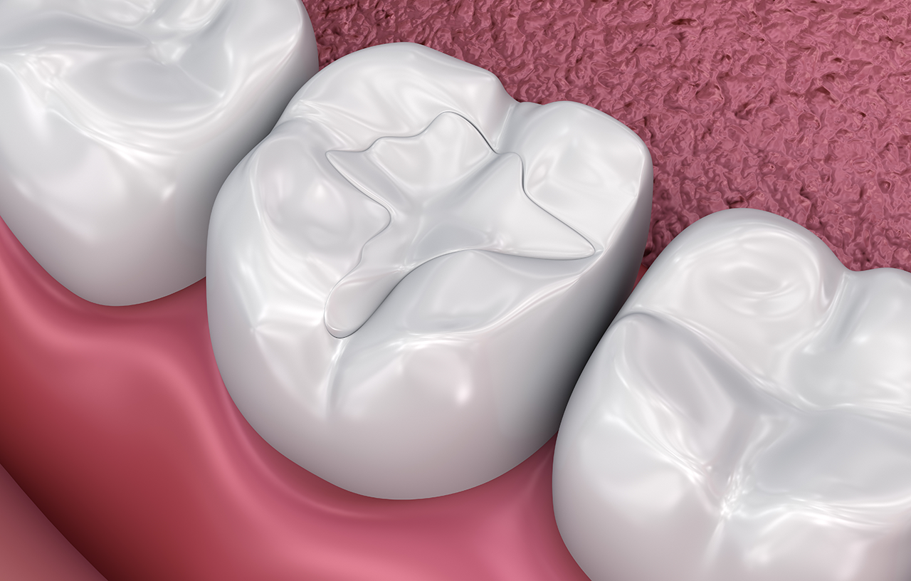 Picture of Tooth-colored fillings