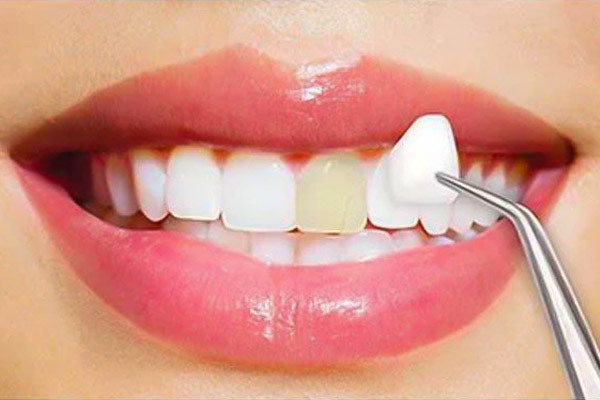 Picture of Dental Veneer